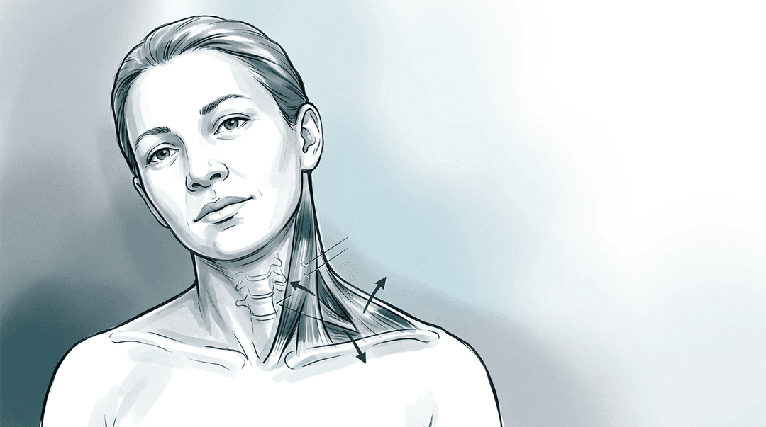 Illustrazione editoriale: torcicollo acuto muscolo-fasciale, catena superficiale e assetto capo-collo