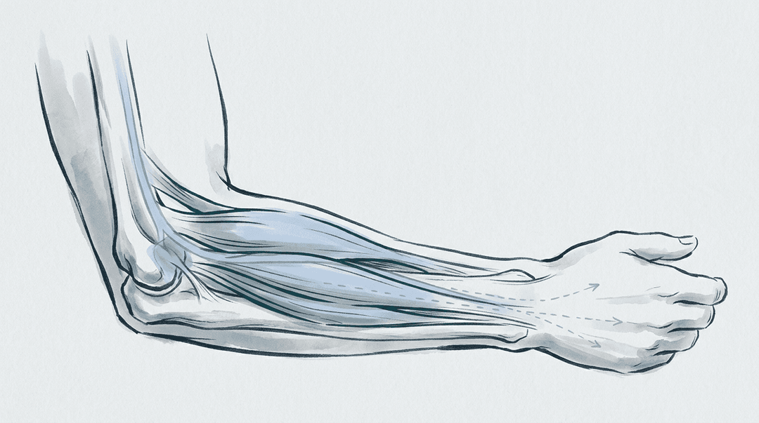 Illustrazione editoriale: dolore laterale del gomito con tunnel radiale e differenziale rispetto all'epicondilalgia