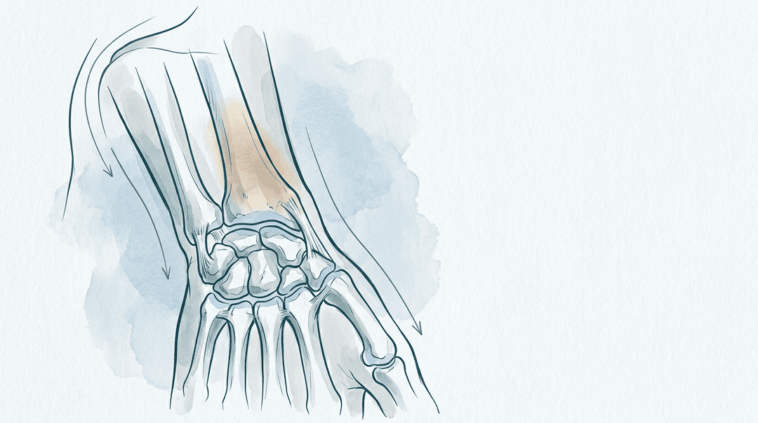 Illustrazione editoriale: rigidità del polso post-immobilizzazione da frattura del radio distale con compensi cervico-scapolari