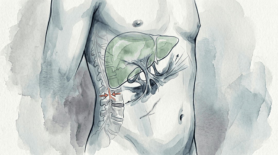 Illustrazione editoriale: post-colecistectomia con aderenze fasciali del quadrante destro e rigidità della cerniera toraco-lombare