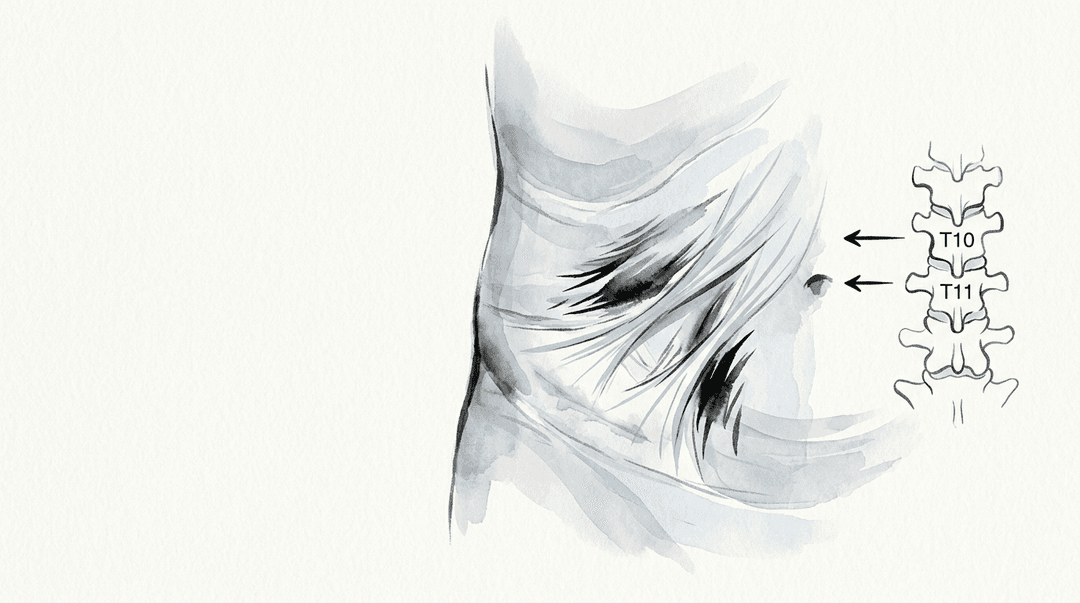Illustrazione editoriale: aderenze addominali post-appendicectomia con rigidità fasciale del quadrante inferiore destro e facilitazione T10-T11