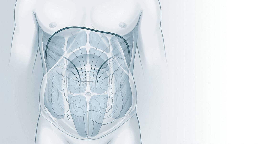 Illustrazione editoriale: distensione addominale funzionale con rigidità addomino-diaframmatica e ipersensibilità viscerale