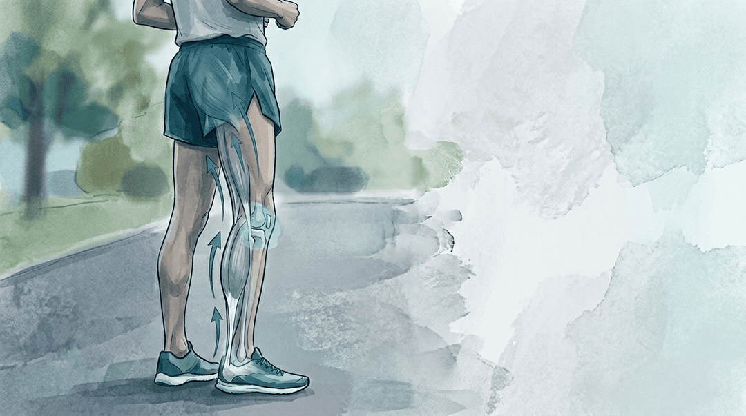 Illustrazione editoriale: tendinopatia achillea ricorrente nel maratoneta e catena posteriore