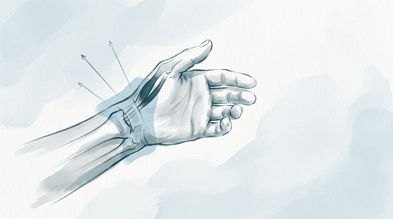 Illustrazione editoriale: tenosinovite di De Quervain con sovraccarico del pollice e compensi scapolo-cervicali